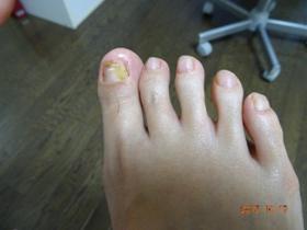 爪切り・爪削り 施術後（右足）さらに2か月後の左足の状態